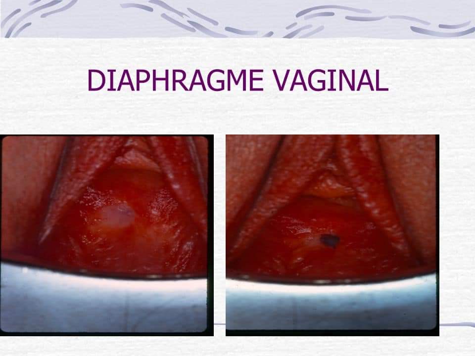 Infowakat - Le Diaphragme vaginal ou malformation du vagin: un ...